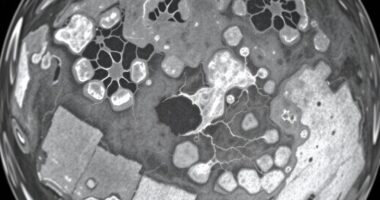 Brustdichtenklassifizierungsmethoden