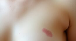 Brusthaut Dellen Rötung