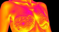 Brust-Thermografie nicht als Ersatz