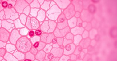 ductales und lobuläres Carcinoma in situ