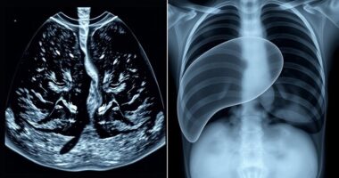 Lungen- und Lebermetastasierungsbildgebung